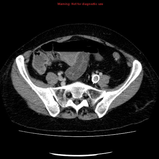 File:Acute gangrenous cholecystitis (Radiopaedia 10123-10661 Axial C+ portal venous phase 77).jpg