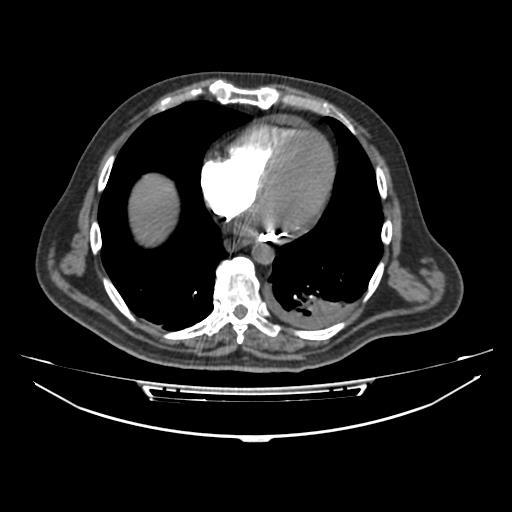 Acute heart failure (CT) (Radiopaedia 79835-93075 Axial C+ arterial phase 39).jpg