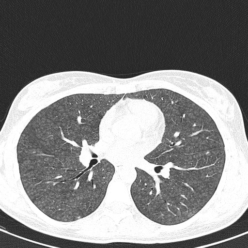 File:Acute hypersensitivity pneumonitis (Radiopaedia 85293-100870 Axial lung window 60).jpg