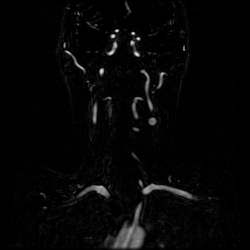 Acute internal carotid artery dissection (Radiopaedia 53541-59632 Coronal MRA 48).jpg