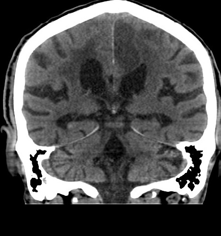 Acute left anterior cerebral artery territory infarction (Radiopaedia 51785-57578 Coronal non-contrast 38).jpg