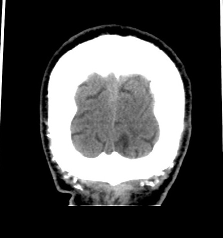 Acute left anterior cerebral artery territory infarction (Radiopaedia 51785-57578 Coronal non-contrast 55).jpg
