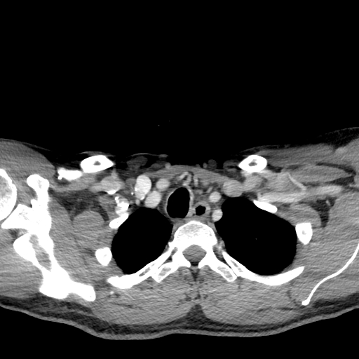 Acute longus colli calcific tendinitis (Radiopaedia 72495-83036 Axial C+ arterial phase 84).jpg