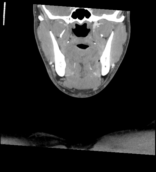 Acute longus colli calcific tendinitis (Radiopaedia 72495-83036 Coronal C+ arterial phase 14).jpg