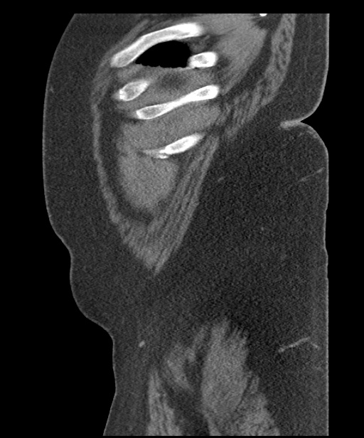 Acute mesenteric venous ischemia (Radiopaedia 46041-50383 Sagittal C+ portal venous phase 112).jpg