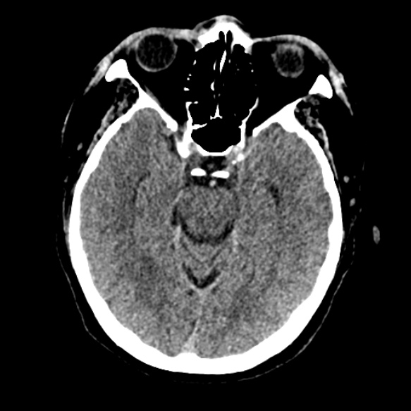 Acute middle cerebral artery territory infarct (Radiopaedia 52380-58283 Axial non-contrast 36).jpg