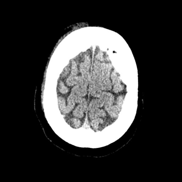 Acute middle cerebral artery territory infarct (Radiopaedia 52380-58283 Axial non-contrast 93).jpg