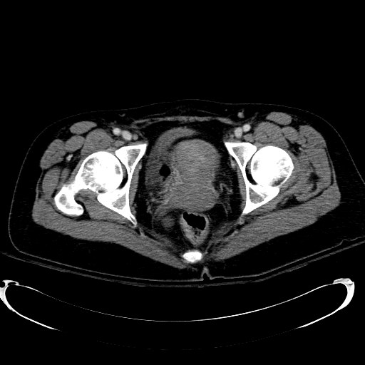 File:Acute myocardial infarction in CT (Radiopaedia 39947-42415 Axial C+ portal venous phase 128).jpg