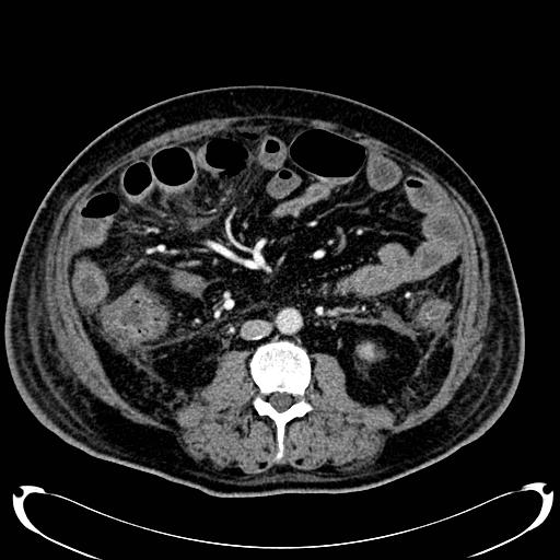 Acute pancreatic necrosis (Radiopaedia 13560-18500 Axial C+ portal venous phase 87).jpg