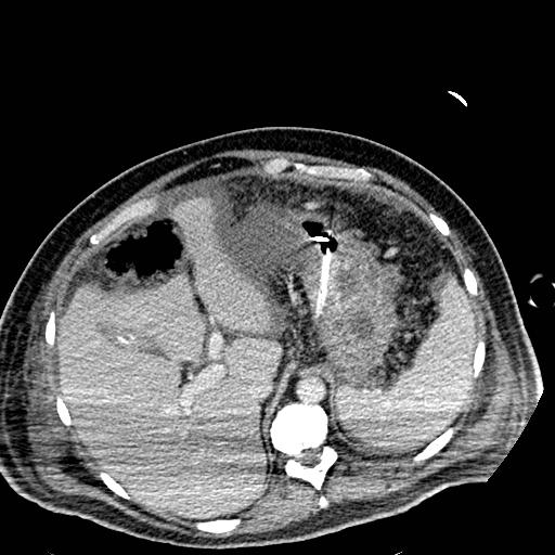 File:Acute pancreatic necrosis (Radiopaedia 13560-18501 Axial C+ portal venous phase 28).jpg