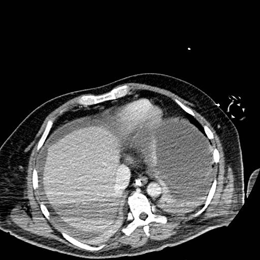 Acute pancreatic necrosis (Radiopaedia 13560-18501 Axial C+ portal venous phase 6).jpg