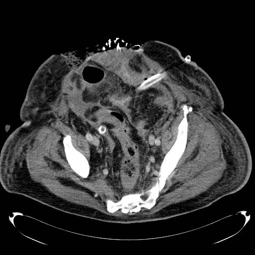 Acute pancreatic necrosis (Radiopaedia 13560-18503 Axial C+ portal venous phase 69).jpg