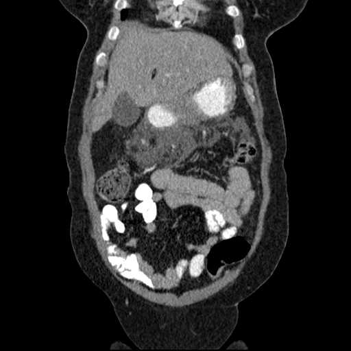 File:Acute pancreatitis (Radiopaedia 20829-20744 Coronal C+ portal venous phase 14).jpg