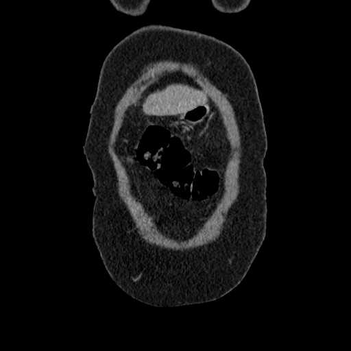 File:Acute pancreatitis (Radiopaedia 20829-20744 Coronal C+ portal venous phase 6).jpg