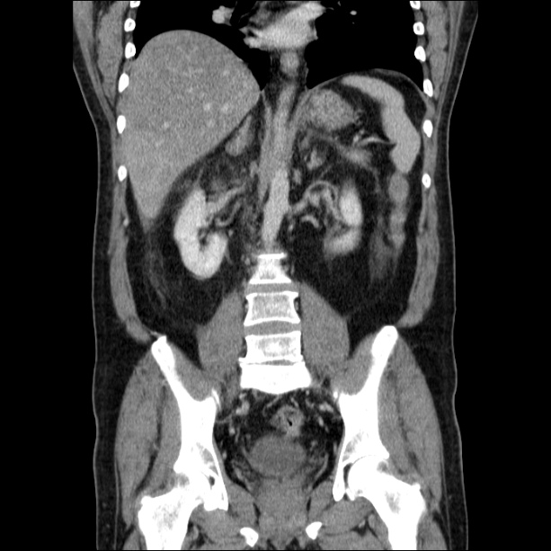 Acute pancreatitis (Radiopaedia 26663-26813 Coronal C+ portal venous phase 40).jpg
