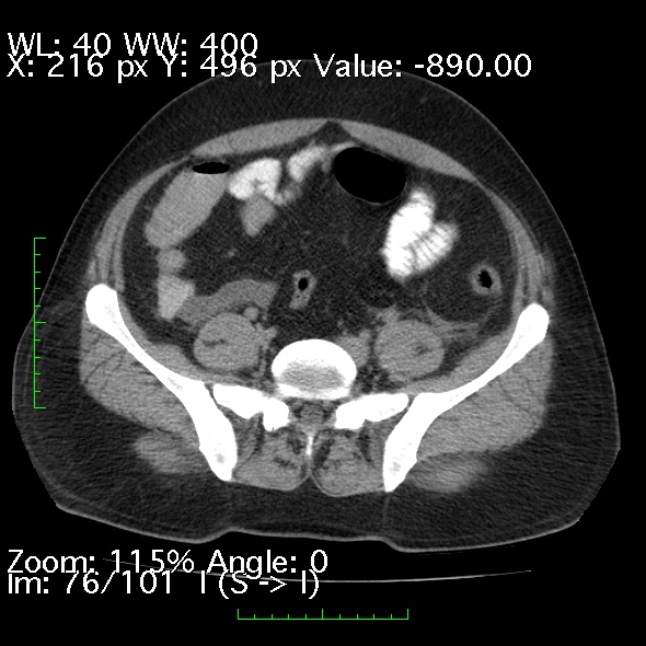 File:Acute pancreatitis (Radiopaedia 34043-35276 Axial non-contrast 76).jpg