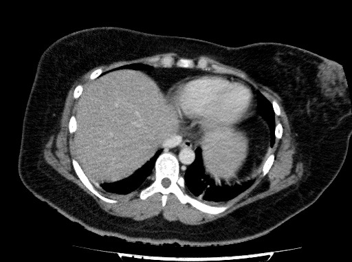 Acute pancreatitis (Radiopaedia 69236-79012 Axial C+ portal venous phase 11).jpg