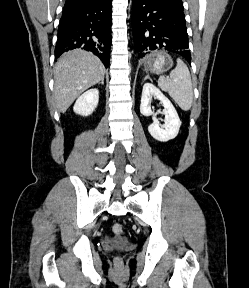 Acute pancreatitis (Radiopaedia 87428-103757 Coronal C+ portal venous phase 67).jpg