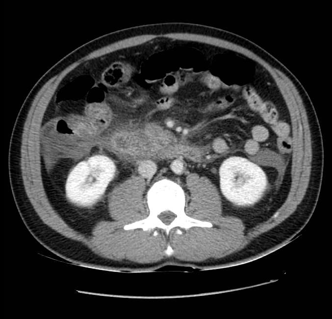 Acute pancreatitis - Balthazar E (Radiopaedia 23080-23110 Axial C+ portal venous phase 34).jpg