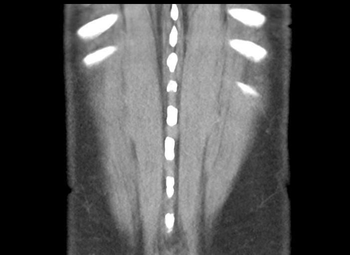 Acute pancreatitis and walled-off necrosis (Radiopaedia 29888-30404 Coronal C+ portal venous phase 49).jpg
