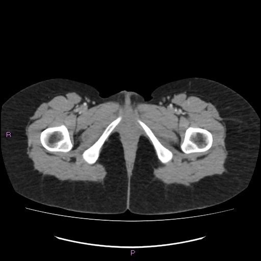 Acute pancreatitis secondary to stone at minor papilla and pancreatic divisum (Radiopaedia 76570-88333 Axial C+ portal venous phase 88).jpg