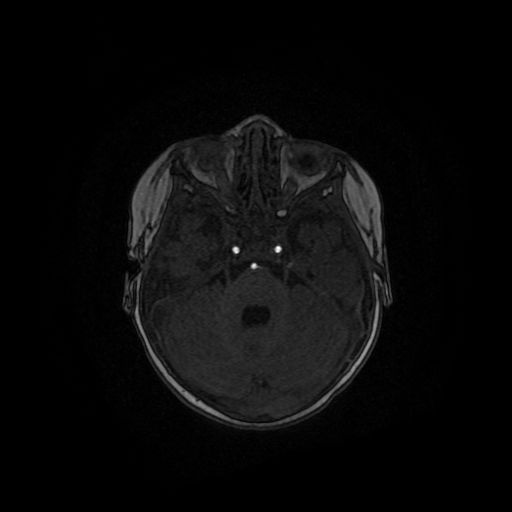 Acute phase of hemiconvulsion-hemiplegia epilepsy syndrome (Radiopaedia 29309-29745 Axial TOF angiography 107).jpg