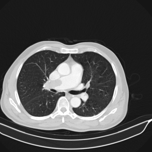 Acute pulmonary embolism (Radiopaedia 69510-79390 Axial lung window 7).jpg