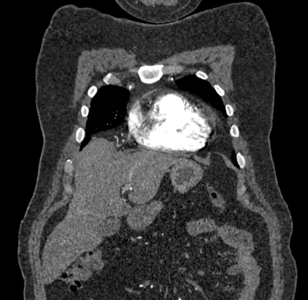 Acute pulmonary embolism with pulmonary infarcts (Radiopaedia 77688-89908 Coronal C+ CTPA 4).jpg