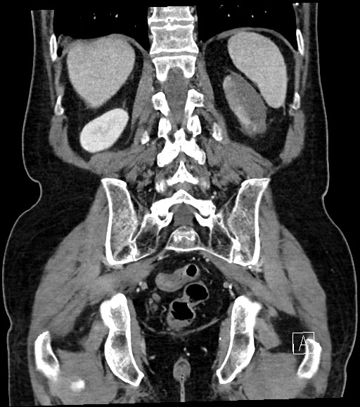 File:Acute renal infarction (Radiopaedia 59375-66736 Coronal C+ portal venous phase 48).jpg