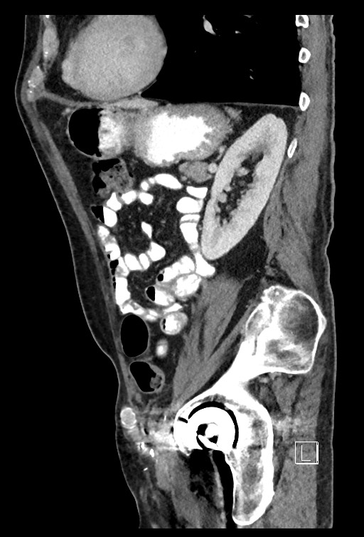 Acute renal infarction - rim capsular enhancement (Radiopaedia 59833-67270 Sagittal C+ portal venous phase 32).jpg