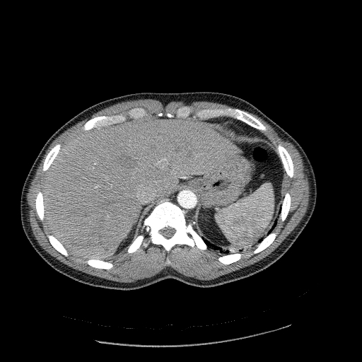 File:Acute segmental pulmonary emboli and pulmonary infarction (Radiopaedia 62264-70444 Axial C+ CTPA 103).jpg
