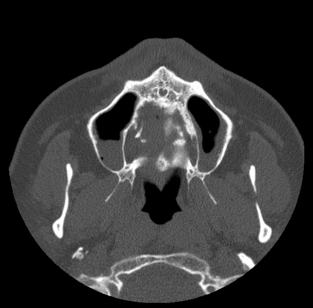Acute sinusitis (Radiopaedia 23161-23215 Axial bone window 10).jpg