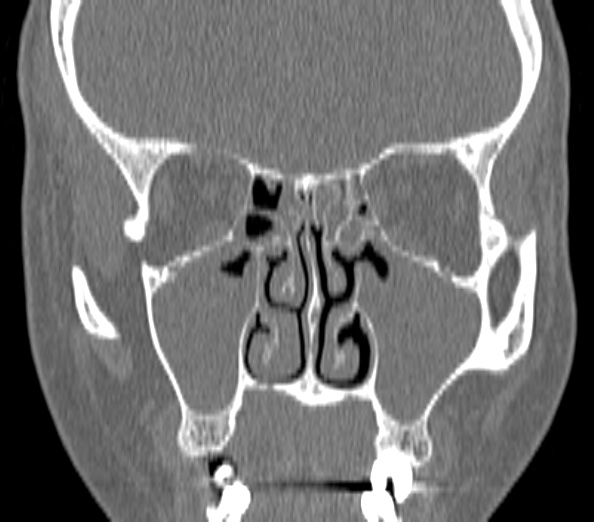 File:Acute sinusitis (Radiopaedia 40564-43158 Coronal bone window 21).jpg