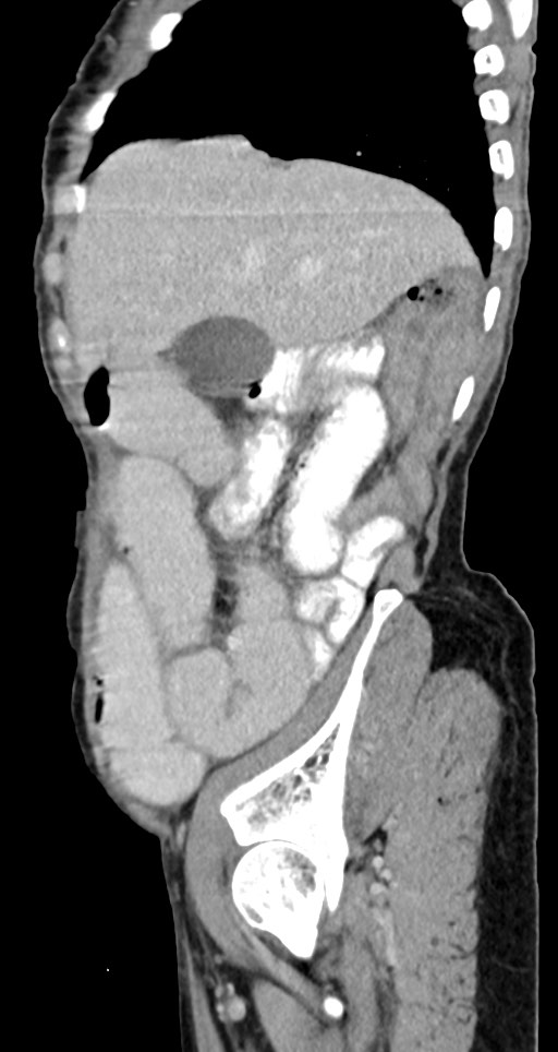 Acute small bowel (ileal) volvulus (Radiopaedia 71740-82139 Sagittal C+ portal venous phase 126).jpg