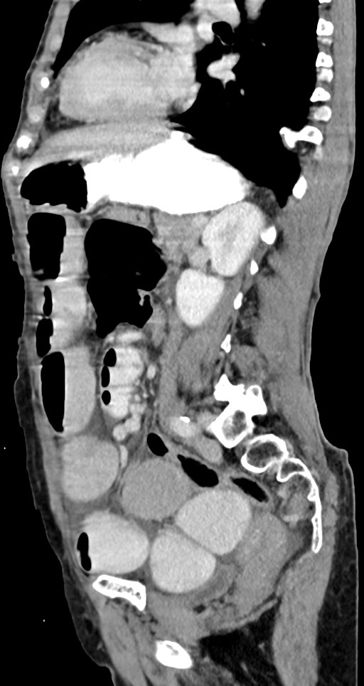 Acute small bowel (ileal) volvulus (Radiopaedia 71740-82139 Sagittal C+ portal venous phase 71).jpg
