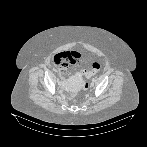 Acute superior mesenteric artery occlusion (Radiopaedia 51288-56960 Axial lung window 64).jpg