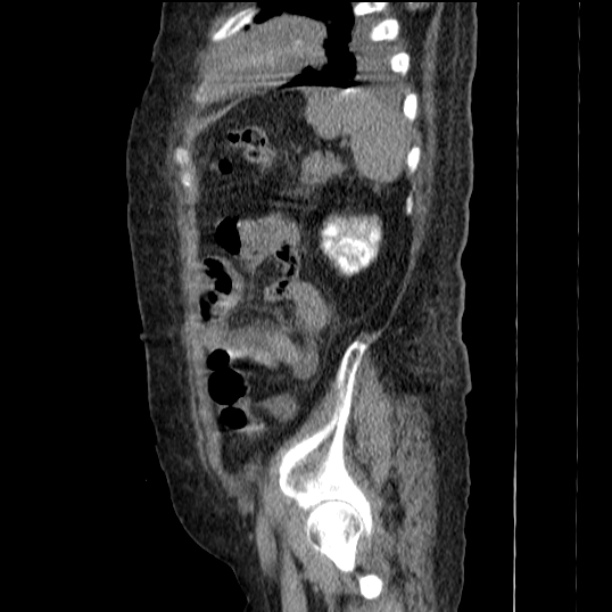 Acute tubular necrosis (Radiopaedia 28077-28334 H 70).jpg