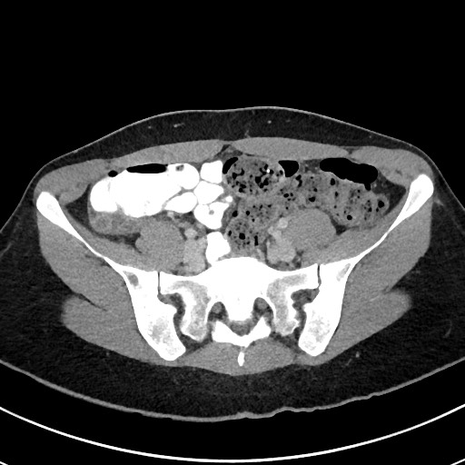 File:Acute uncomplicated appendicitis (Radiopaedia 61374-69304 Axial C+ portal venous phase 88).jpg