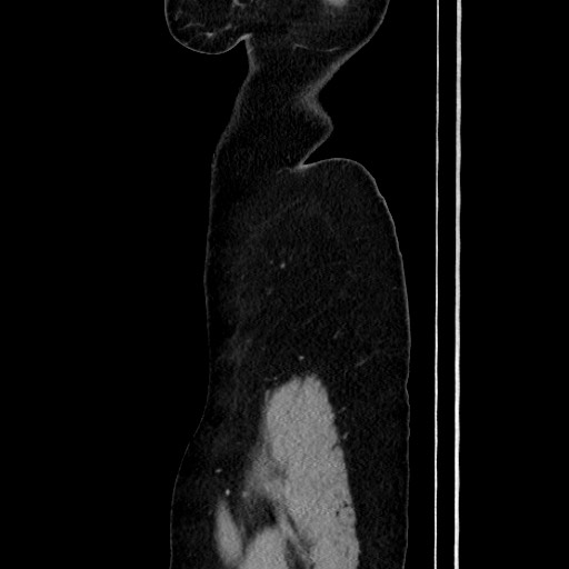 Acute uncomplicated appendicitis (Radiopaedia 73704-84499 Sagittal C+ portal venous phase 37).jpg