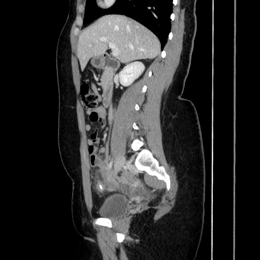 File:Acute uncomplicated appendicitis (Radiopaedia 73704-84499 Sagittal C+ portal venous phase 95).jpg