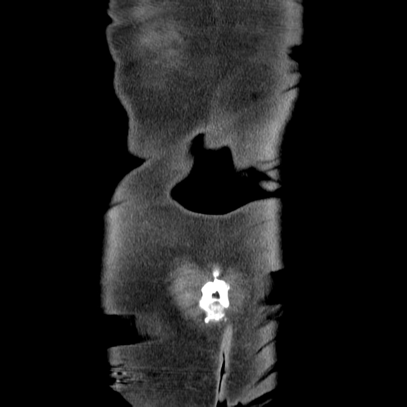 Adenocarcinoma of colon with entero-colic fistula (Radiopaedia 22832-22852 Coronal C+ portal venous phase 52).jpg