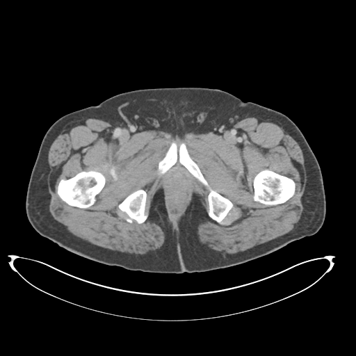 Adenocarcioma of rectum- T1 lesion (Radiopaedia 36921-38547 Axial C+ portal venous phase 93).png