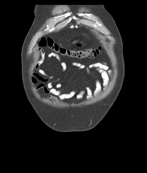 Adenocarcioma of rectum- T1 lesion (Radiopaedia 36921-38547 Coronal C+ portal venous phase 8).png
