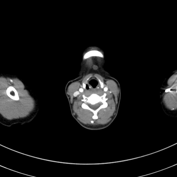 Adenocystic carcinoma of the trachea (Radiopaedia 47677-52525 Axial C+ arterial phase 19).jpg