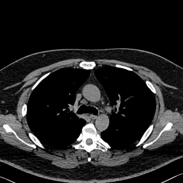 Adenoid cystic carcinoma of the trachea (Radiopaedia 49042-54137 Axial non-contrast 120).jpg