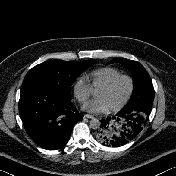 Adenoid cystic carcinoma of the trachea (Radiopaedia 49042-54137 Axial non-contrast 220).jpg