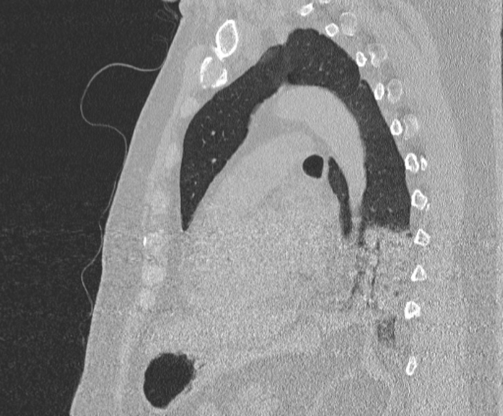 Adenoid cystic carcinoma of the trachea (Radiopaedia 49042-54137 Sagittal lung window 283).jpg