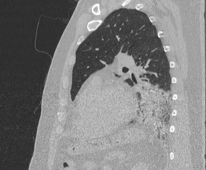 Adenoid cystic carcinoma of the trachea (Radiopaedia 49042-54137 Sagittal lung window 308).jpg