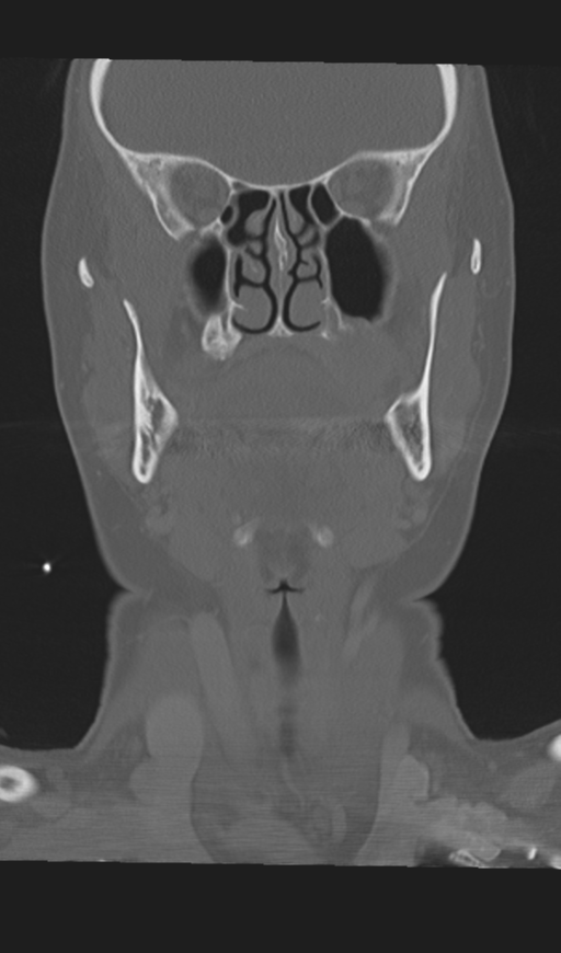 Adenoid cystic tumor of palate (Radiopaedia 46980-51518 Coronal bone window 27).png