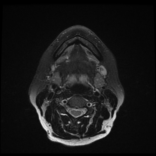 File:Adenoid cystic tumor of palate (Radiopaedia 46980-51519 Axial T2 fat sat 11).png
